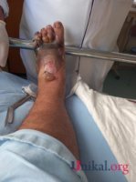 "HB Güvən" klinikasının professoru qazinin ayağını görün nə hala saldı - DƏHŞƏTLİ FOTOLAR "HB Güvən" klinikasının professoru qazinin ayağını görün nə hala saldı - DƏHŞƏTLİ FOTOLAR