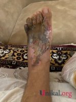 "HB Güvən" klinikasının professoru qazinin ayağını görün nə hala saldı - DƏHŞƏTLİ FOTOLAR "HB Güvən" klinikasının professoru qazinin ayağını görün nə hala saldı - DƏHŞƏTLİ FOTOLAR