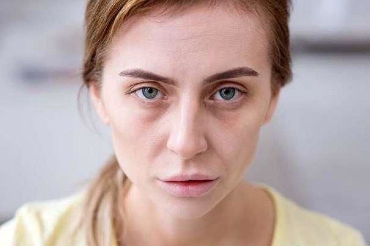 Solğun dəri ilə işarələnən XƏSTƏLİKLƏR Solğun dəri ilə işarələnən XƏSTƏLİKLƏR